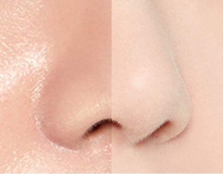 a woman's nose before and after a nose lift
